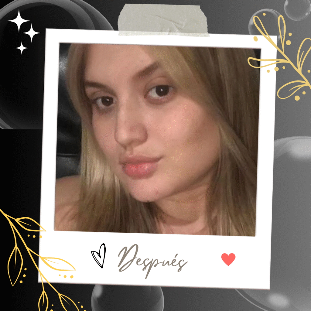 bichectomia tratamiento despues