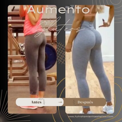 Aumento de Glúteos