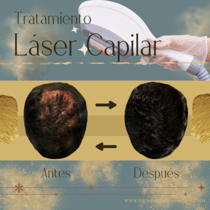 Tratamiento capilar con láser de baja…