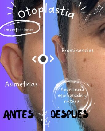 Otoplastia