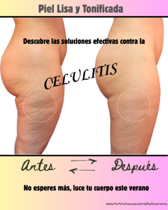 Tratamientos para la Celulitis