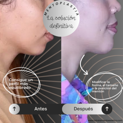 Mentoplastia