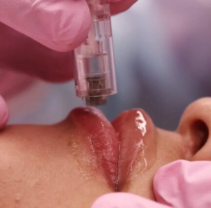 Aumento de Labios